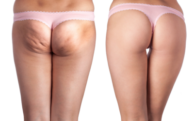 How to Get Rid of Cellulite