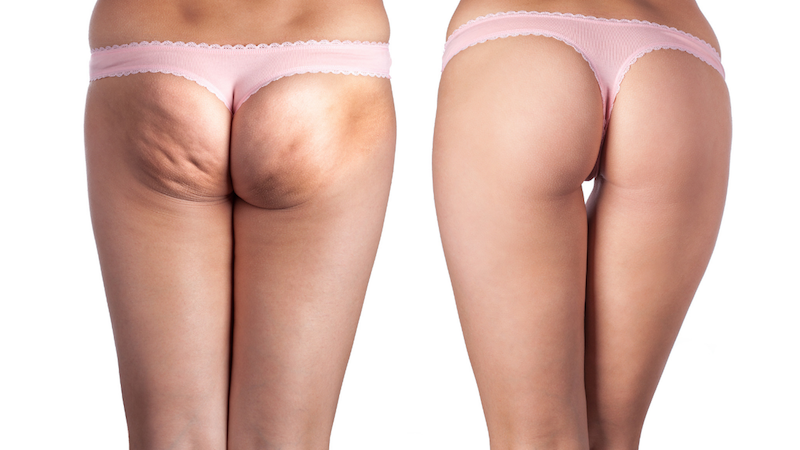 How Is Cellulite Forever? - Scientific American can Save You Time, Stress, and Money. thumbnail