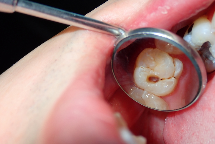 a picture of a cavity in a tooth during a dental exam