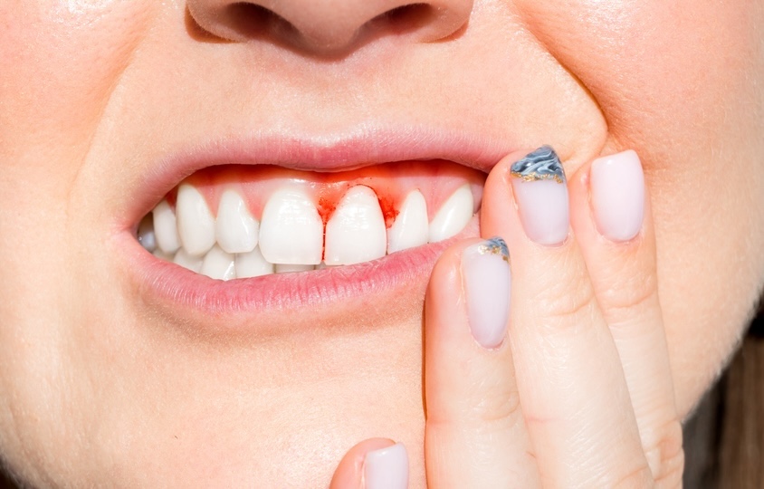 a picture of a woman with infected, bleeding gums