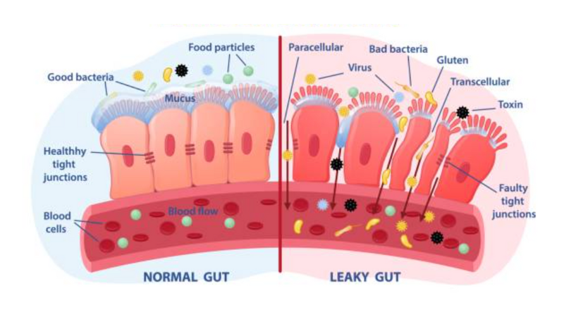 an illustration of a normal gut compared to a leaky gut