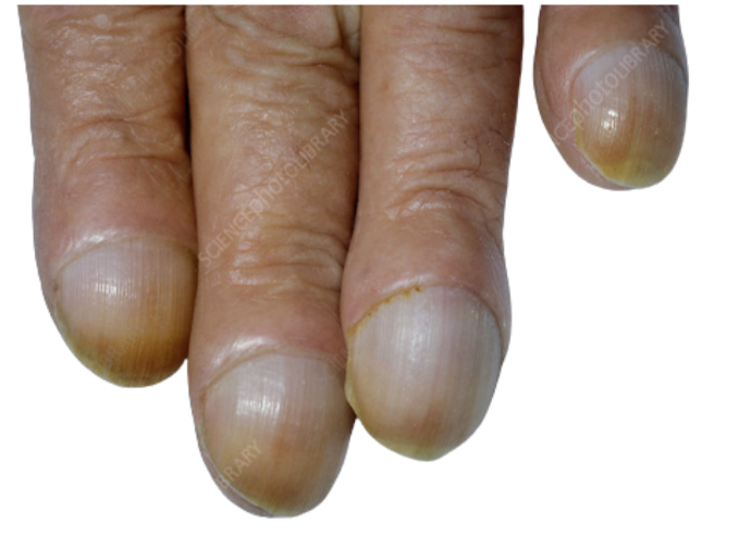Rounded, bulbous fingertips showing nail clubbing, often linked to poor oxygen circulation or chronic inflammation.