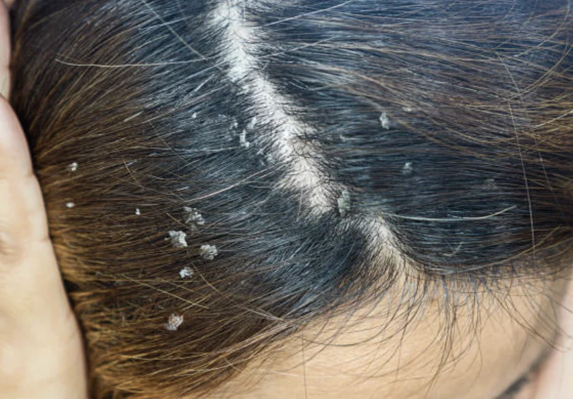 Close-up of dandruff flakes along the scalp and part line in dark hair.