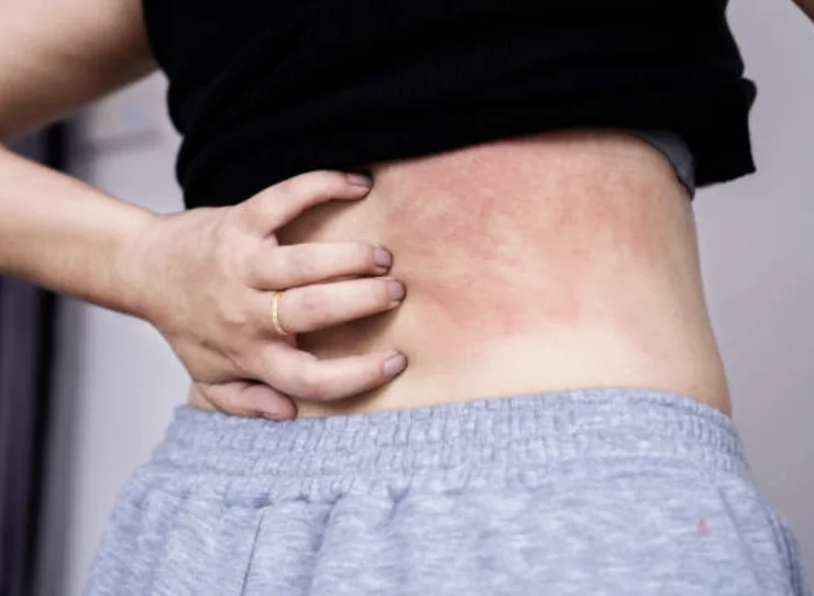 Person scratching a red irritated eczema patch on the lower back.