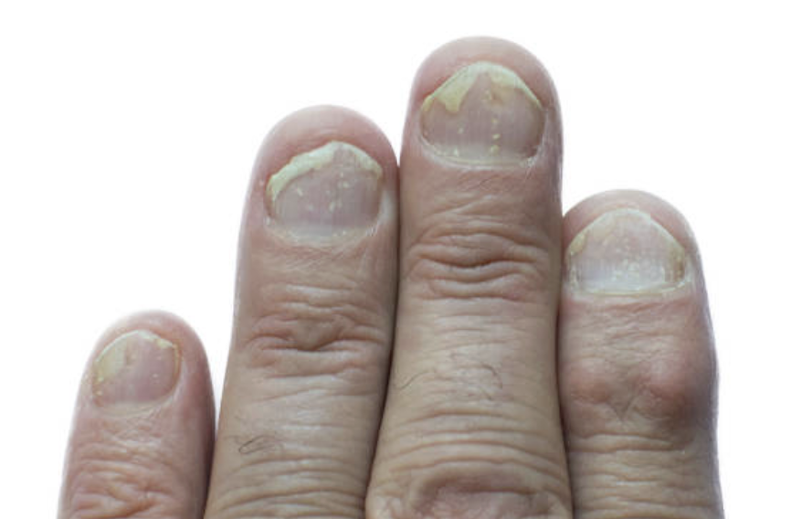 Nails lifting and separating from nail beds, possibly from thyroid imbalance, low zinc, or chronic inflammation.