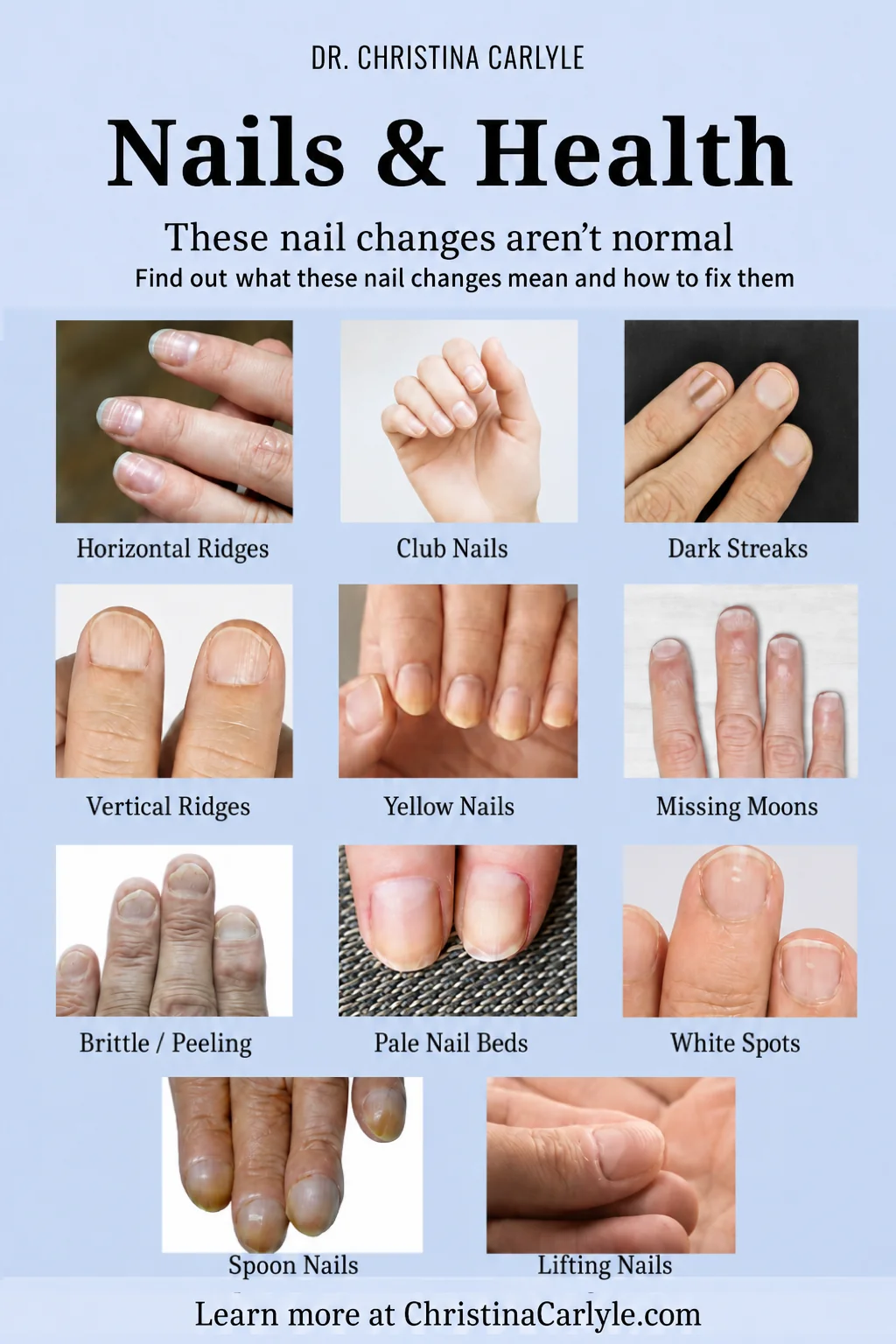 Irregular Nails and Health Pinterest graphic titled “Nails & Health” by Dr. Christina Carlyle showing examples of nail changes including horizontal ridges, club nails, dark streaks, vertical ridges, yellow nails, missing moons, brittle peeling nails, pale nail beds, white spots, spoon nails, and lifting nails.