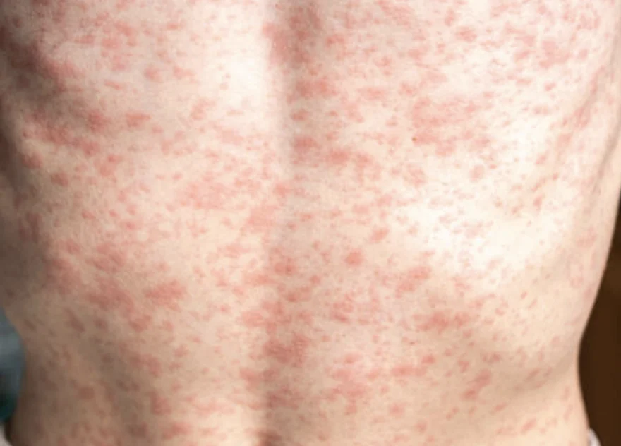 Red blotchy rash covering the skin on a person’s back.