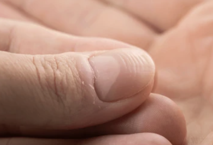 Close-up of hands showing horizontal ridges on fingernails, a common sign of stress or nutrient deficiency.