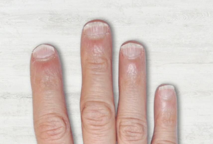 Nails curved upward in a spoon shape, a sign of low iron or oxygen deficiency.