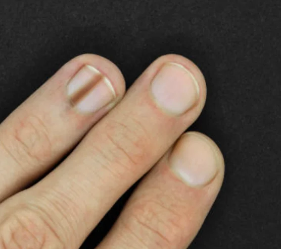 Finger with dark vertical streak under the nail, possible pigmentation or early sign of nail trauma or melanoma.