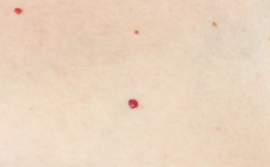 Cluster of bright red cherry angiomas on fair skin, small vascular skin growths.