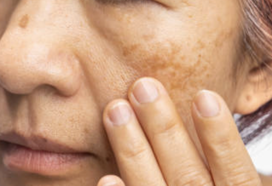 Close-up of facial hyperpigmentation with uneven dark spots and sun-damaged skin tone.