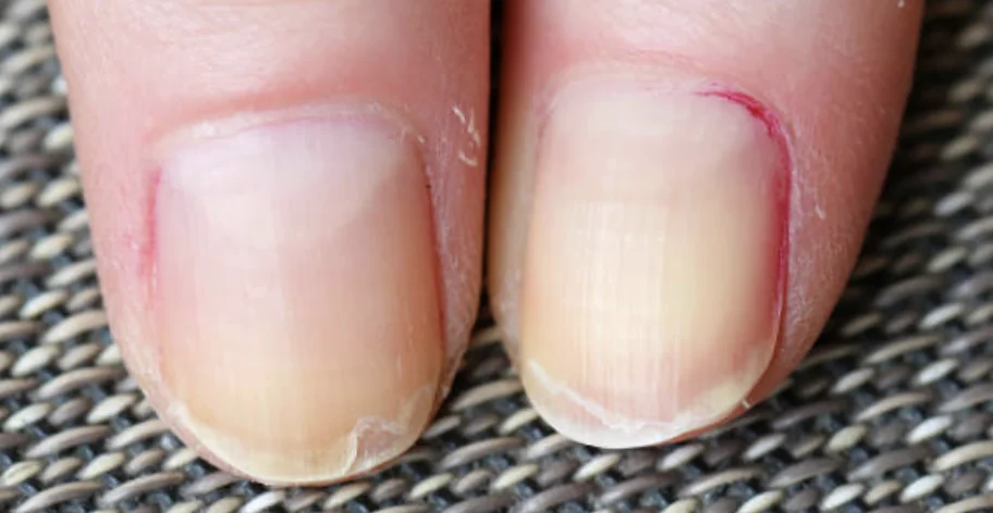 Fingers with peeling and flaky nails caused by weak keratin, low thyroid, or protein deficiency.