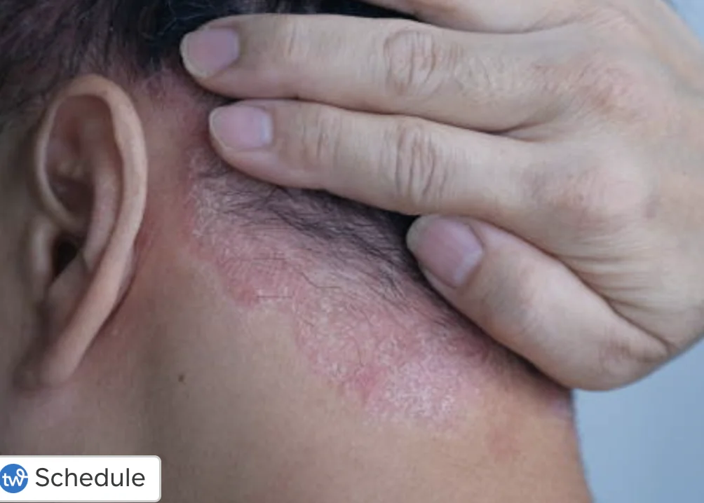 Dry red scaly psoriasis patch along the hairline and behind the ear.