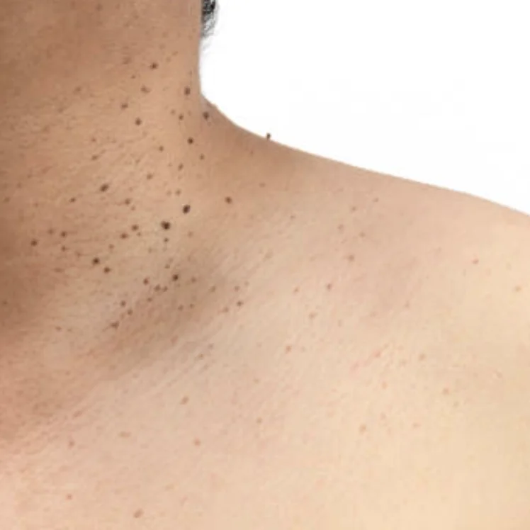 Small flesh-colored skin tags on the neck and upper chest, common benign skin condition.