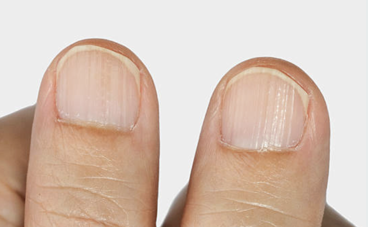 Thumb nails with vertical ridges that may indicate low stomach acid, adrenal fatigue, or mineral imbalance.