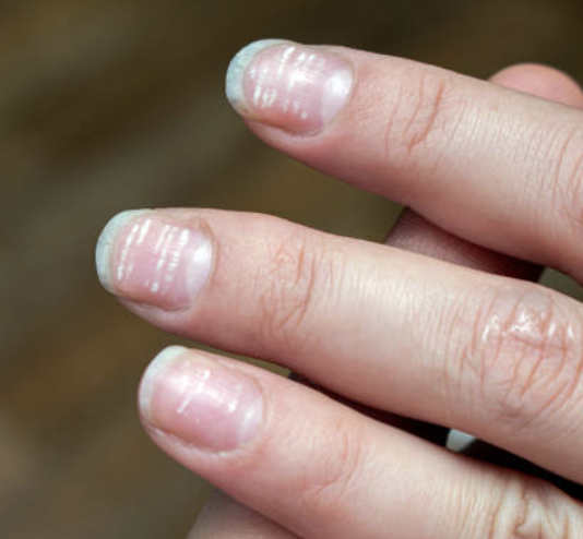 Fingers showing white spots on nails, often linked to zinc deficiency or minor trauma.