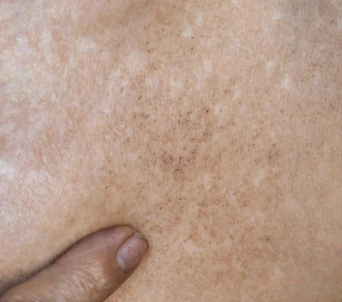 White spots on the upper back and shoulders showing loss of pigmentation and uneven skin tone.
