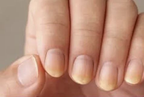Fingernails with yellow discoloration, often related to liver sluggishness, toxin buildup, or fungal infection.