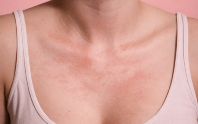 Histamine Allergy Symptoms – Red flags to watch for