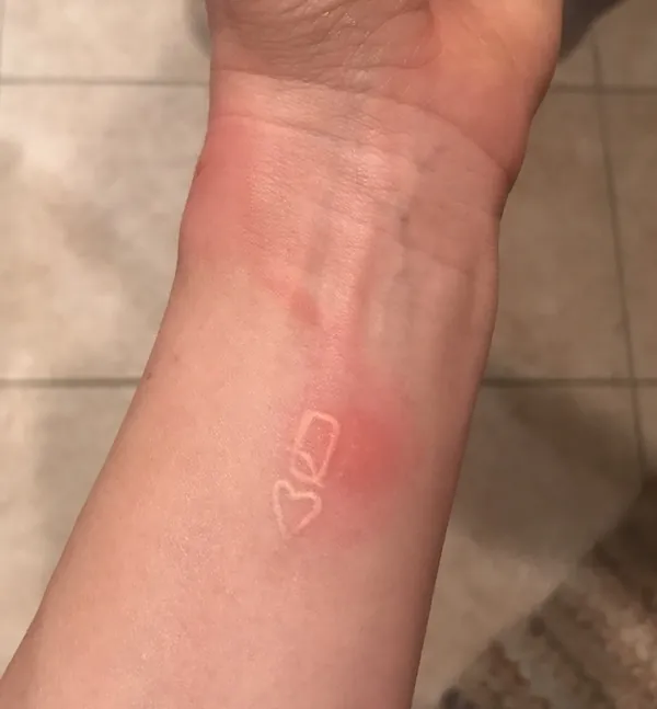 Bullseye Rash from a Bite on Dr. Christina Carlyle's wrist