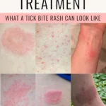 Pinterest pin for Dr. Christina Carlyle about tick bite treatment, featuring a clean cream and pink design with a collage of tick bite rash examples and the headline “What a tick bite rash can look like.”