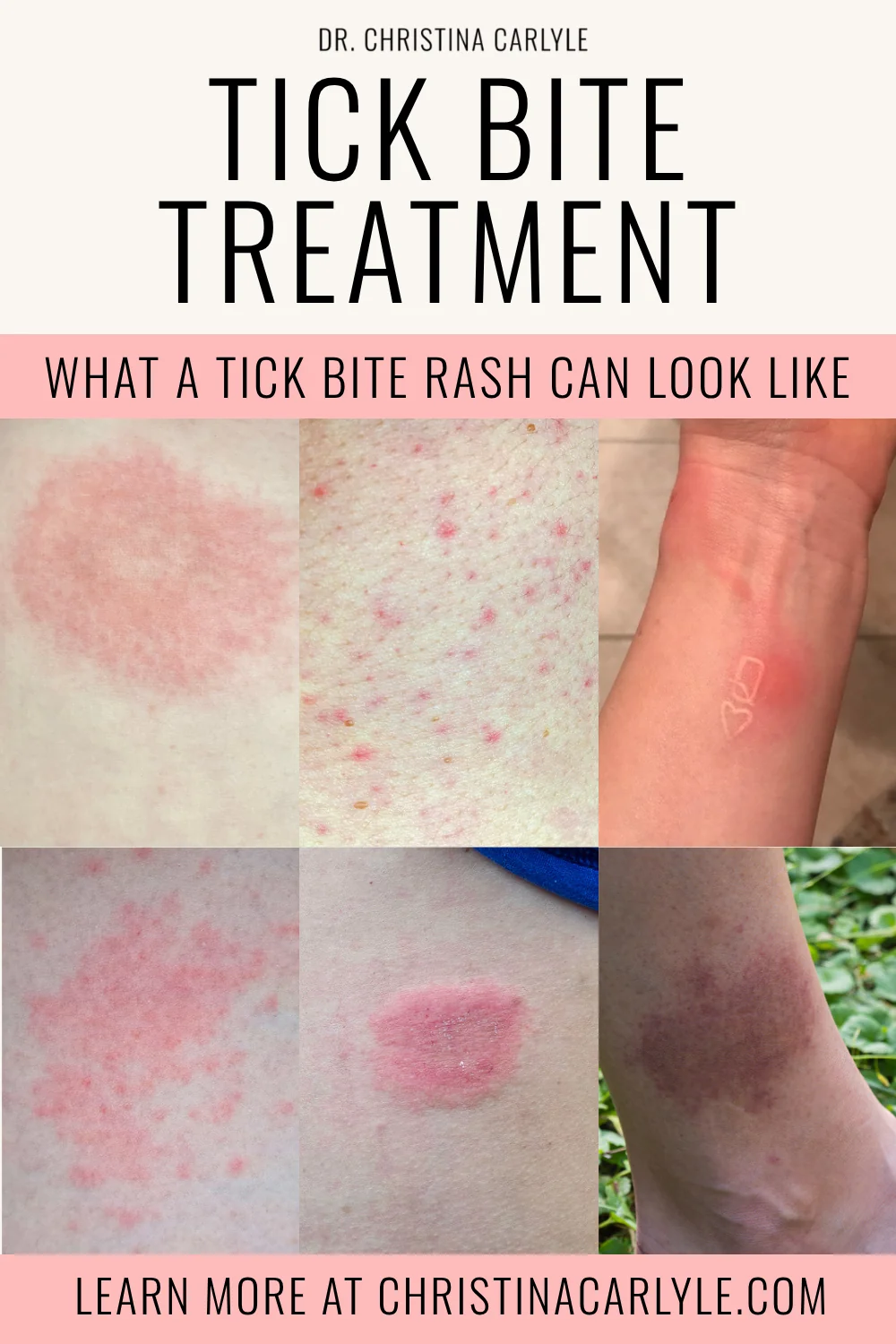 Pinterest pin for Dr. Christina Carlyle about tick bite treatment, featuring a clean cream and pink design with a collage of tick bite rash examples and the headline “What a tick bite rash can look like.”