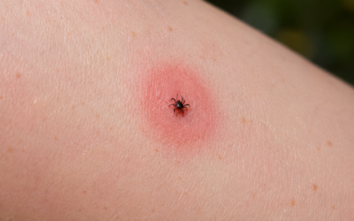 Tick Bite Treatment – Do This Immediately After a Tick Bite