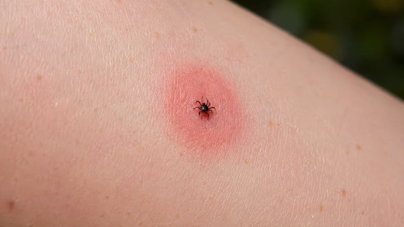 Cover image for Dr. Christina Carlyle’s tick bite treatment guide, showing a close-up photo of a tick bite on skin with redness around the bite, designed to help readers recognize what a tick bite may look like.
